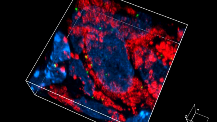 tumori solidi e liquidi Tumori, nuova immunoterapia promettente contro quelli solidi con metastasi